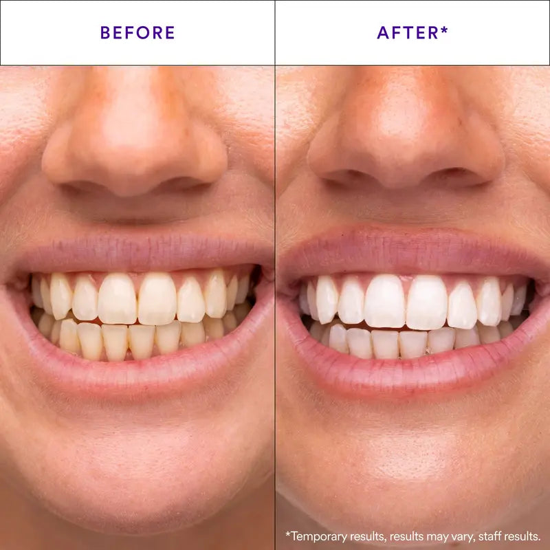 🦷Hismile V34 Whitening Strips: Advanced Teeth Whitening + Purple Colour Correction for Brighter Smiles-TI